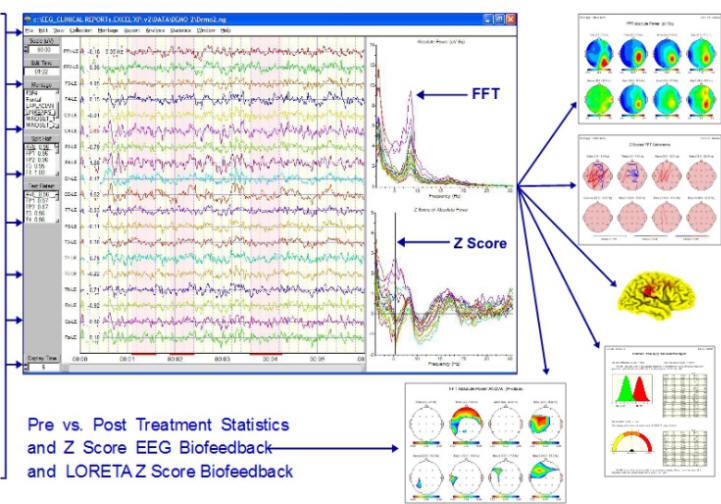 neurofeedback