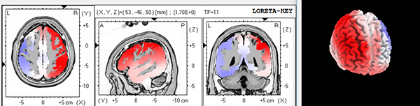 neurofeedback